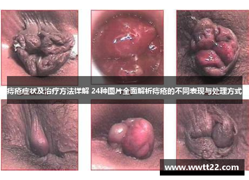 痔疮症状及治疗方法详解 24种图片全面解析痔疮的不同表现与处理方式
