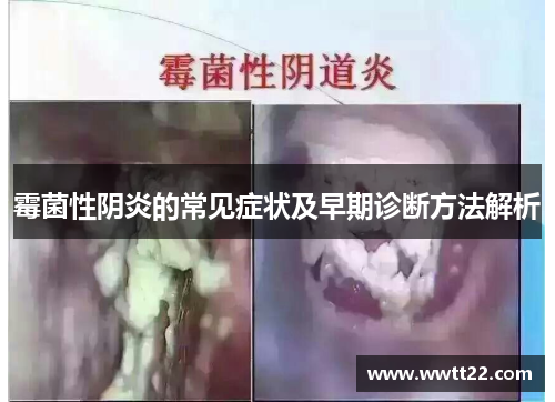 霉菌性阴炎的常见症状及早期诊断方法解析