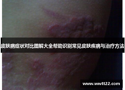 皮肤病症状对比图解大全帮助识别常见皮肤疾病与治疗方法